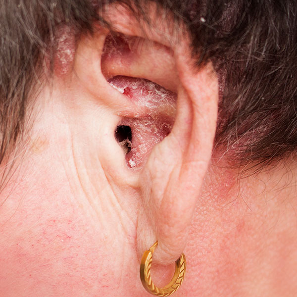 Psoriasis inversa in oor